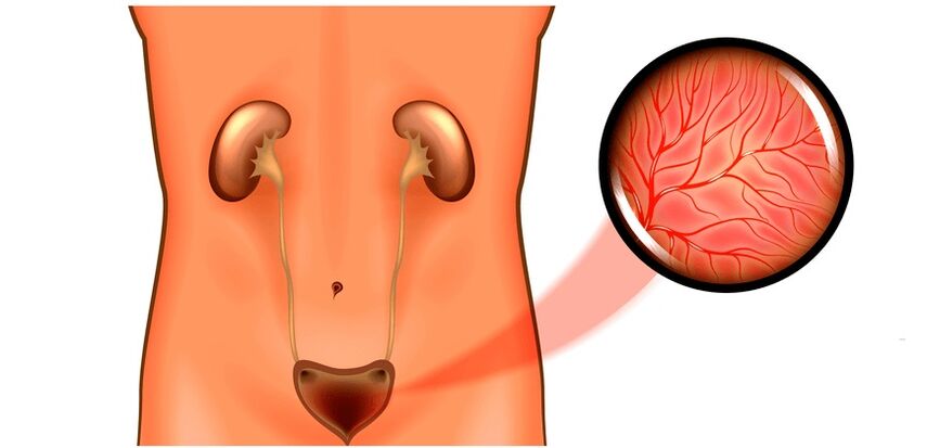 Male symptoms and cystitis in treatment