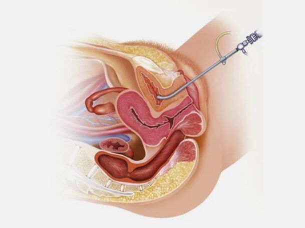 Diagnosing cystitis