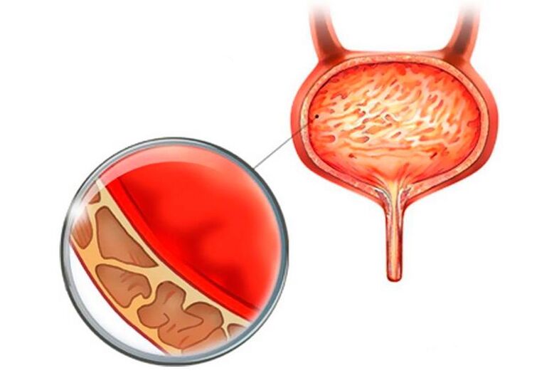 Bladder mucosa inflammation with cystitis